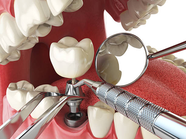 Best Emergency Tooth Extraction in Weweantic, MA
